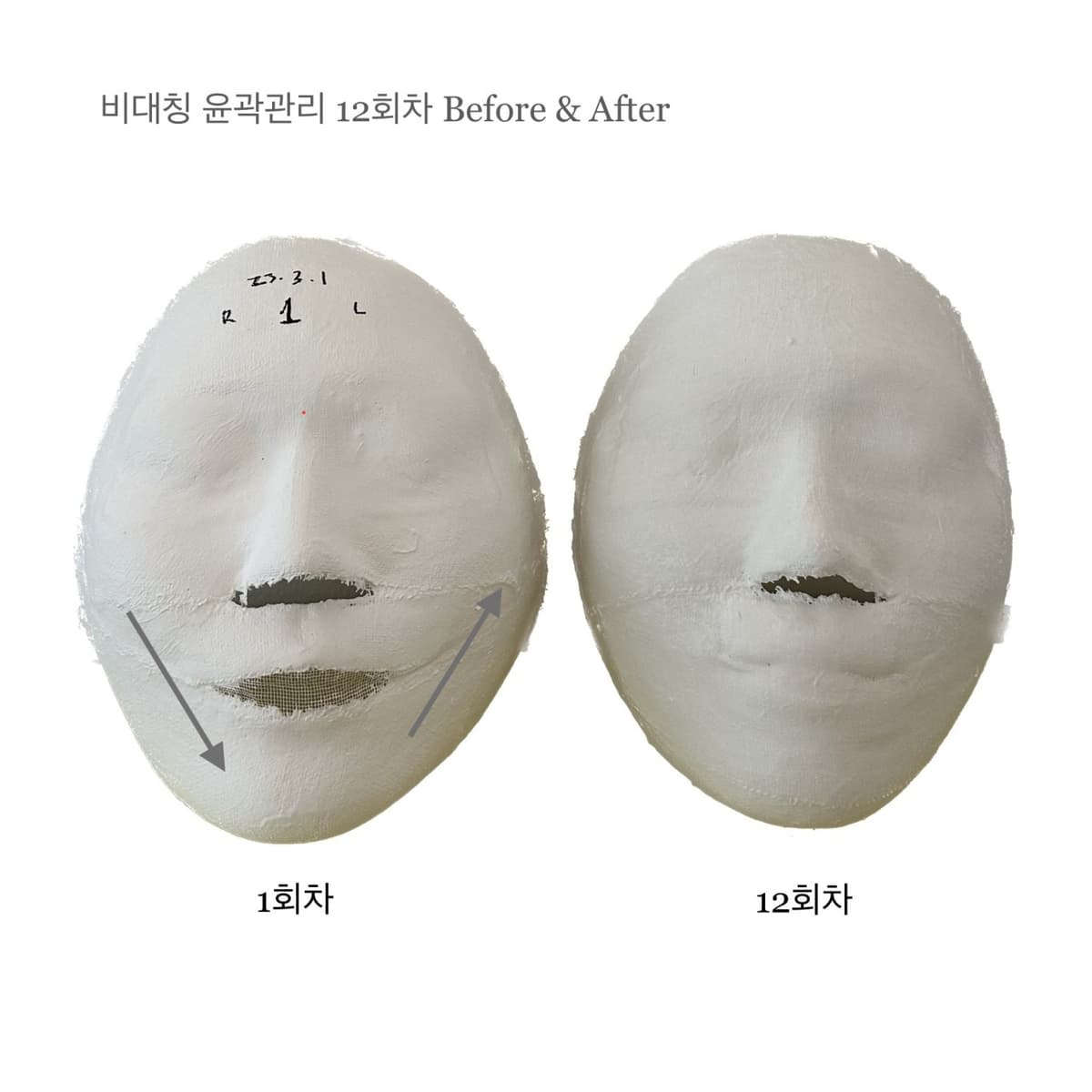 비대칭 윤곽관리 12 sessions