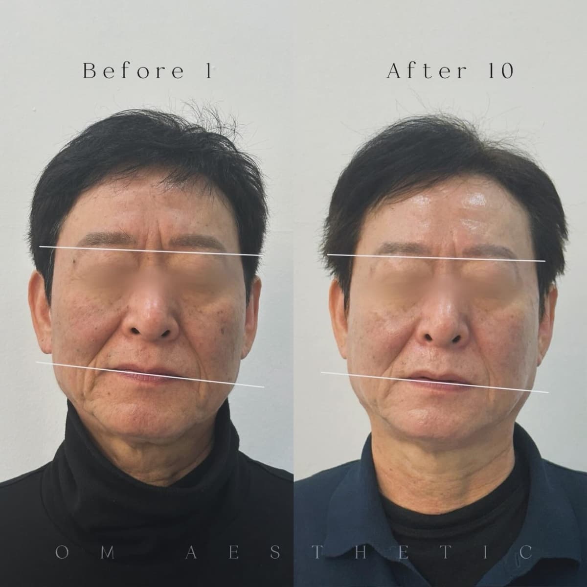 좌우 눈높이·입꼬리 수평 라인 개선