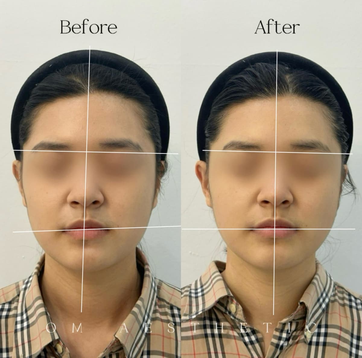 턱선·광대 좌우 균형 회복