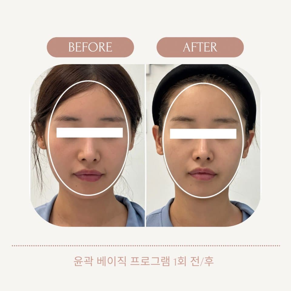 1회 시술로 타원 가이드 기준 얼굴 폭 및 하관 볼륨 초기 축소