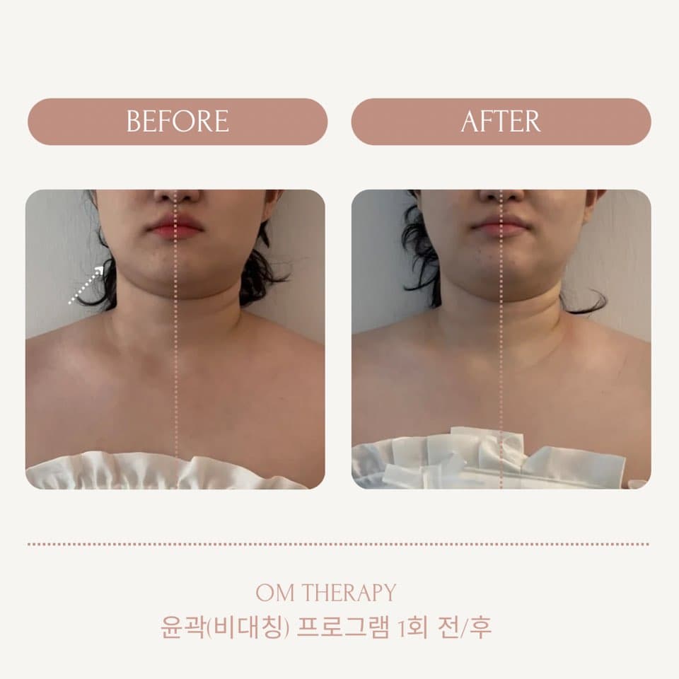 1회 만에 턱라인 좌우 높이차 및 어깨 수평 라인 초기 개선