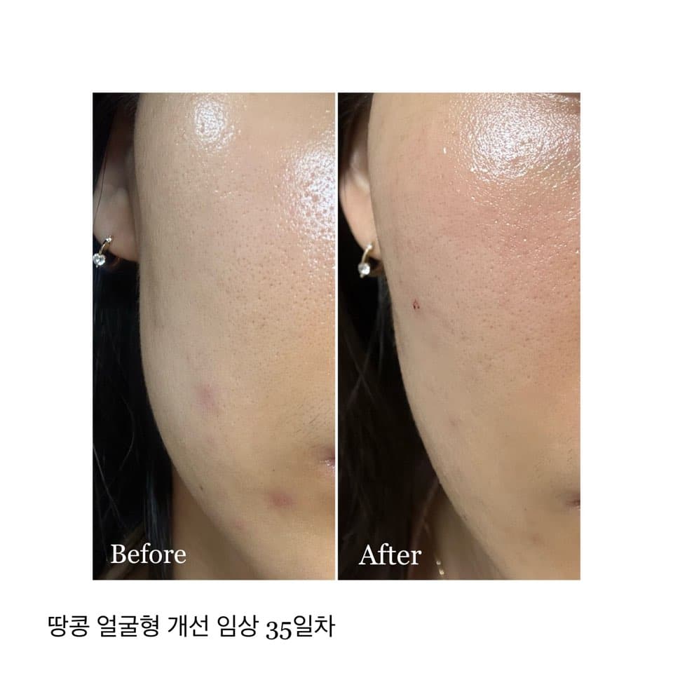 35일간 볼~턱 윤곽 라인 정돈 및 하관 볼륨 축소