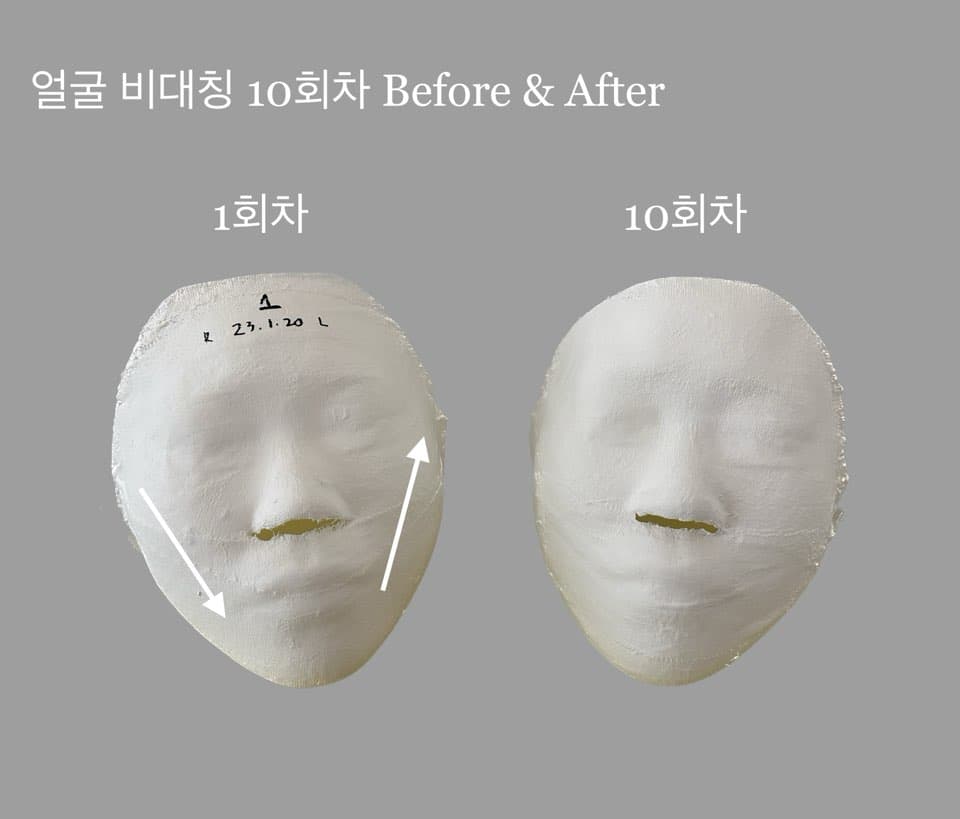 얼굴 비대칭 관리 10 sessions