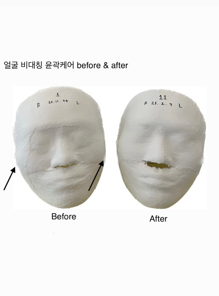 비대칭 윤곽케어 11 sessions