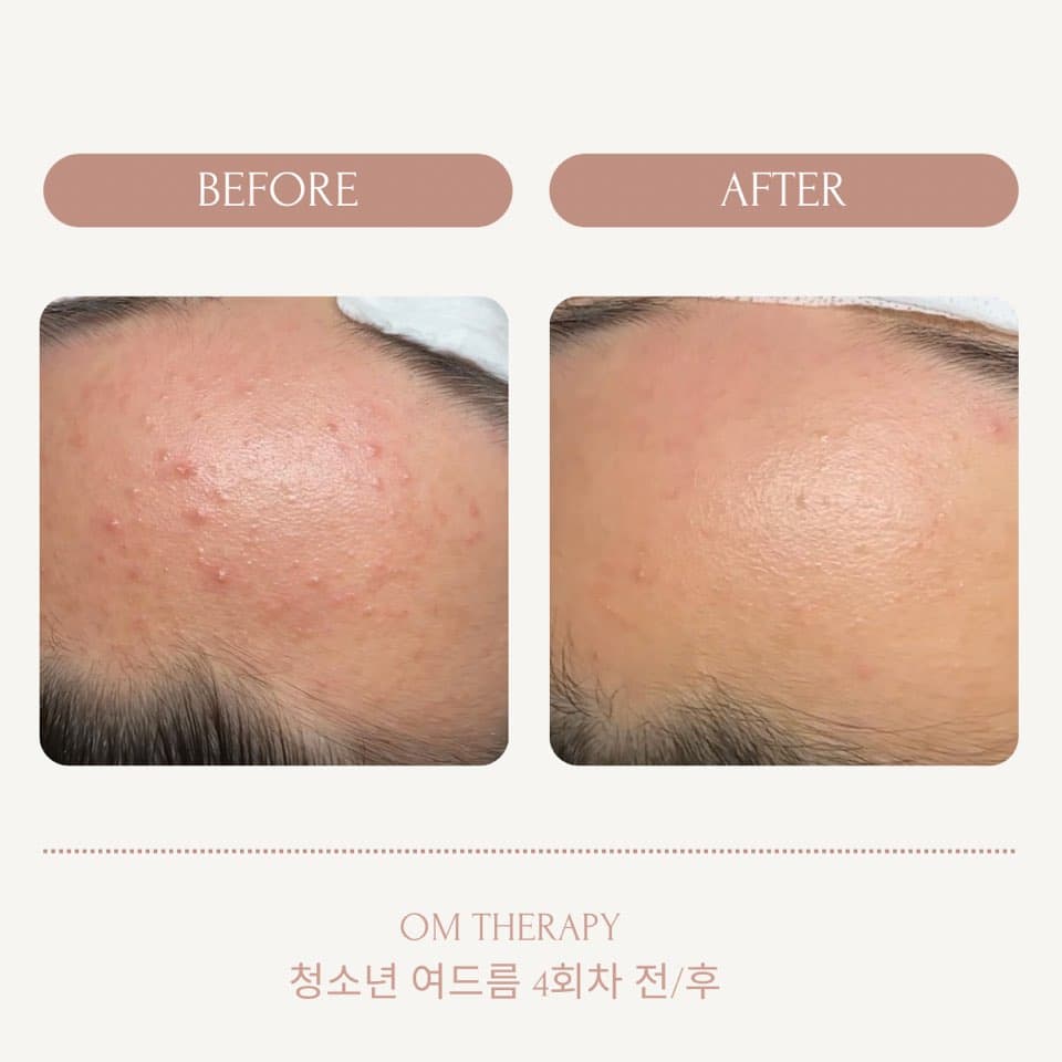 청소년 여드름 4회차 전/후