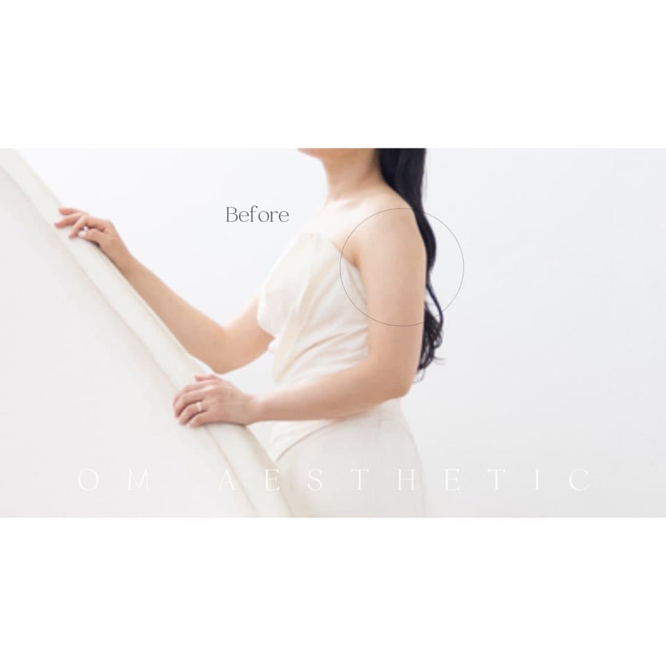 웨딩 팔뚝 관리 Before